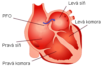 PFO - patent foramen ovale